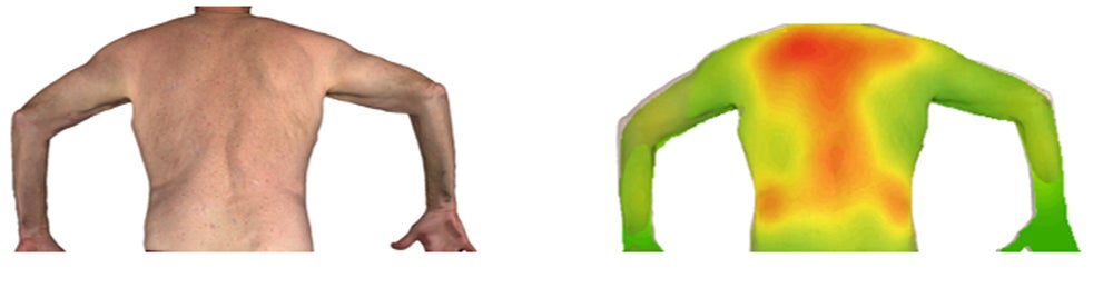 A scan of a torso and same scan rendered as a sun-damage heatmap.