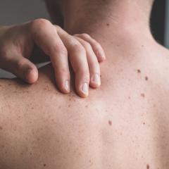 Artificial intelligence in skin cancer diagnostics